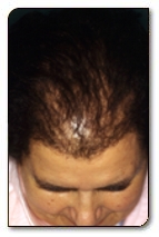 Alopecia femminile
